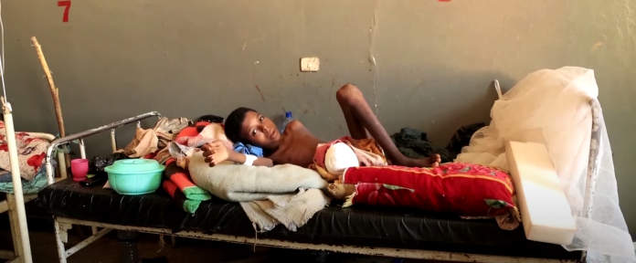 Fëmijet e gjymtuar në Etiopi