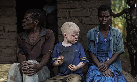 Një fëmijë albin mes vendasëve afrikanë